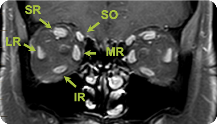 Healthy-Eye-Orbital -issue