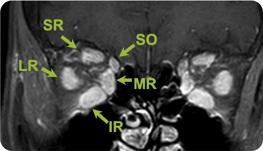 Increased-Tissue-Volume-in-TED
