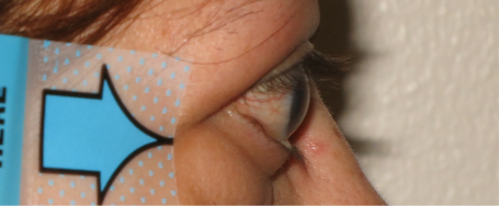 Side view of bulging eyes before treatment