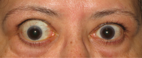 Front view of protruding eyes before treatment