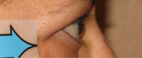 Side view of bulging eyes after TEPEZZA treatment (Week 24)