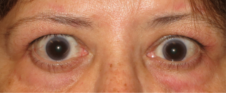 Front view of protruding eyes after TEPEZZA treatment