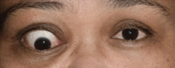 Baseline left eye strabismus