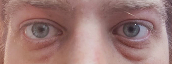 Front view of post-treatment proptosis and diplopia