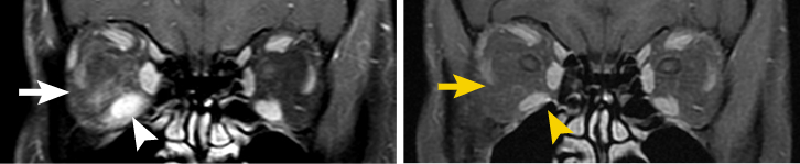 Thyroid Eye Disease MRI showing baseline and post-treatment results of TEPEZZA at Week 24