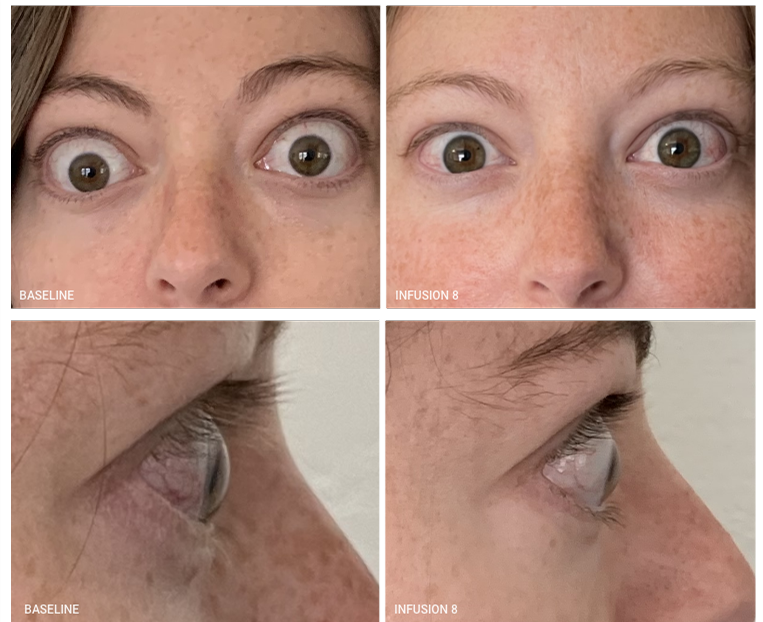 infustion-comparison-8